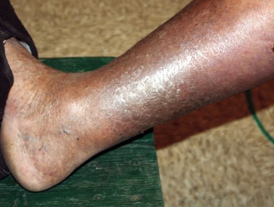 Ronnie Zorn’s dog bites almost three months after his June 9 attack. (Contributed photo)