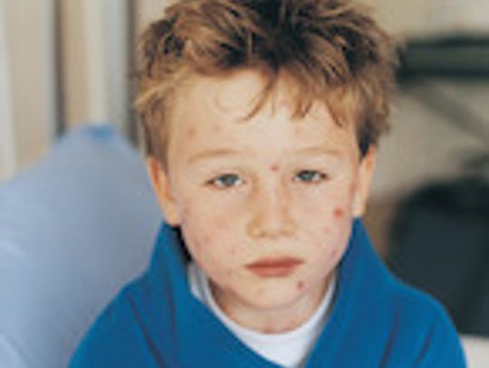 At least eight school-aged children in West Texas have contracted measles. Photo courtesy of MetroCreative.