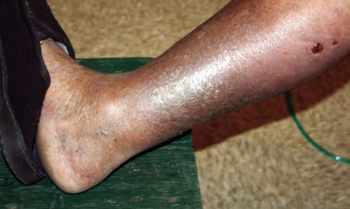 Ronnie Zorn’s dog bites almost three months after his June 9 attack. (Contributed photo)
